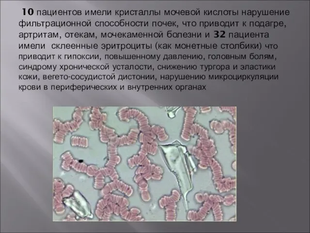 10 пациентов имели кристаллы мочевой кислоты нарушение фильтрационной способности почек, что приводит