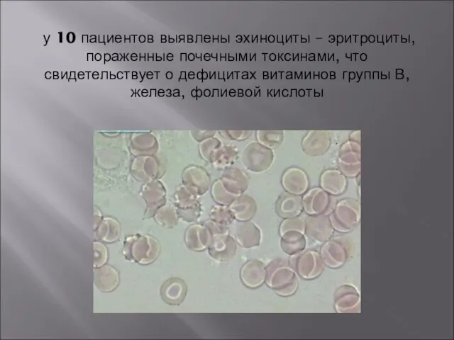 у 10 пациентов выявлены эхиноциты – эритроциты, пораженные почечными токсинами, что свидетельствует