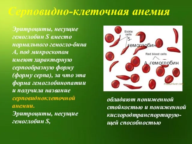 Серповидно-клеточная анемия Эритроциты, несущие гемоглобин S вместо нормального гемогло-бина А, под микроскопом