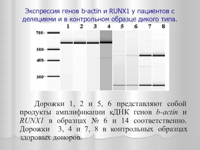 Экспрессия генов b-actin и RUNX1 у пациентов с делециями и в контрольном