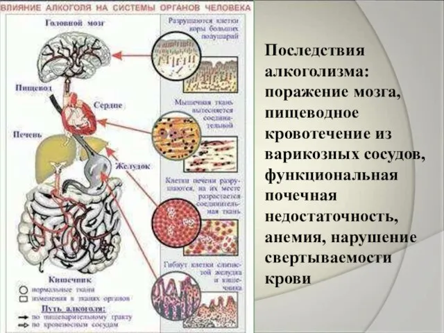 Последствия алкоголизма: поражение мозга, пищеводное кровотечение из варикозных сосудов, функциональная почечная недостаточность, анемия, нарушение свертываемости крови