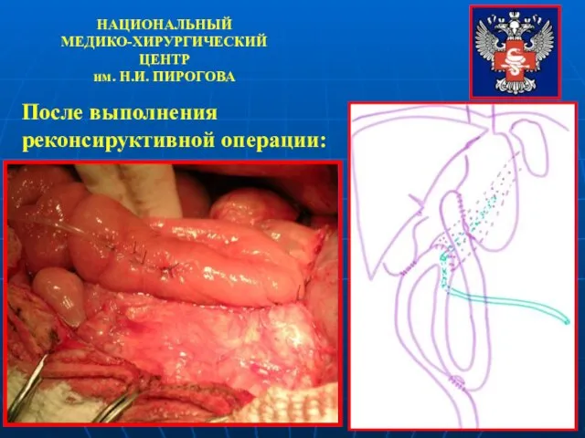 НАЦИОНАЛЬНЫЙ МЕДИКО-ХИРУРГИЧЕСКИЙ ЦЕНТР им. Н.И. ПИРОГОВА После выполнения реконсируктивной операции: