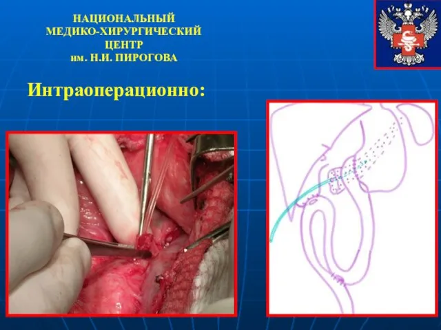 НАЦИОНАЛЬНЫЙ МЕДИКО-ХИРУРГИЧЕСКИЙ ЦЕНТР им. Н.И. ПИРОГОВА Интраоперационно:
