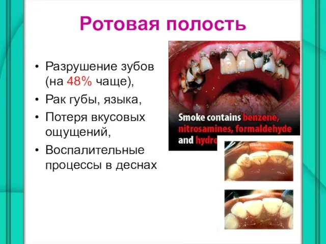 Ротовая полость Разрушение зубов (на 48% чаще), Рак губы, языка, Потеря вкусовых