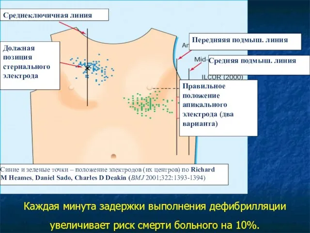 Каждая минута задержки выполнения дефибрилляции увеличивает риск смерти больного на 10%. Среднеключичная