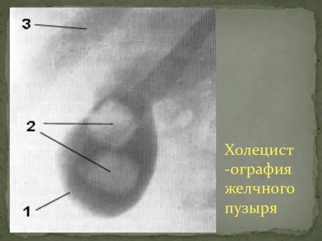 Холецист-ография желчного пузыря