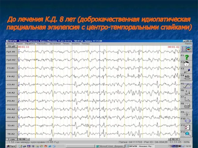 До лечения К.Д. 8 лет (доброкачественная идиопатическая парциальная эпилепсия с центро-темпоральными спайками)