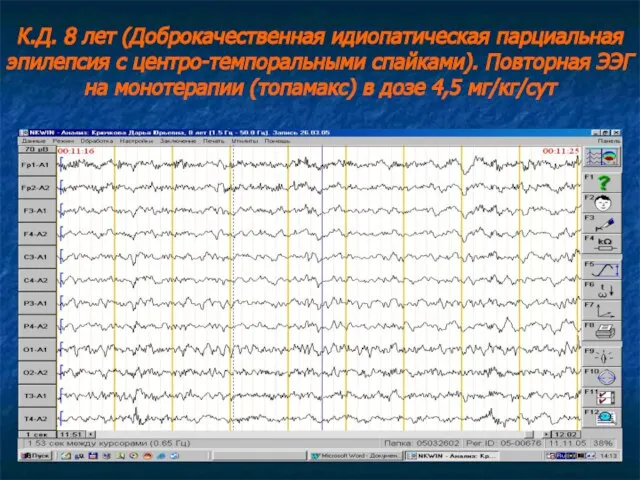 К.Д. 8 лет (Доброкачественная идиопатическая парциальная эпилепсия с центро-темпоральными спайками). Повторная ЭЭГ