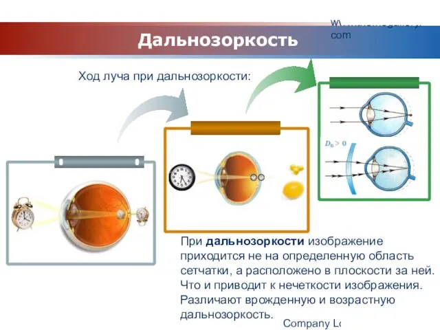 www.themegallery.com Company Logo Ход луча при дальнозоркости: Дальнозоркость При дальнозоркости изображение приходится