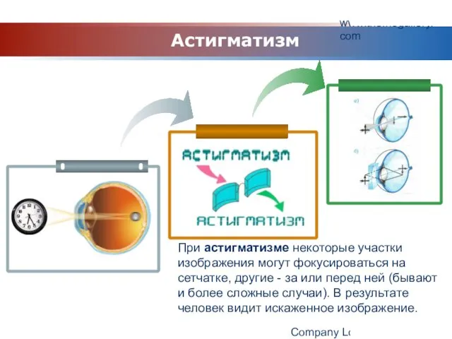 www.themegallery.com Company Logo При астигматизме некоторые участки изображения могут фокусироваться на сетчатке,