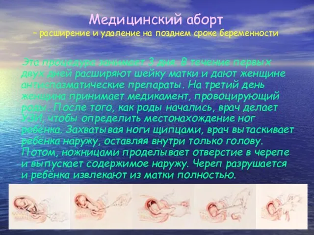 Медицинский аборт – расширение и удаление на позднем сроке беременности Эта процедура