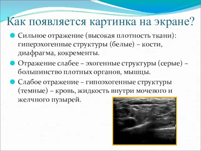 Как появляется картинка на экране? Сильное отражение (высокая плотность ткани): гиперэхогенные структуры