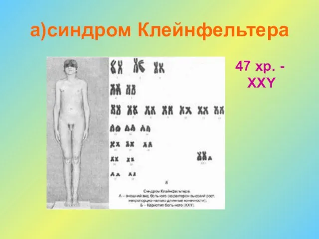 а)синдром Клейнфельтера 47 хр. - XXY