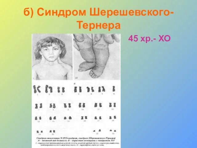 б) Синдром Шерешевского-Тернера 45 хр.- ХО