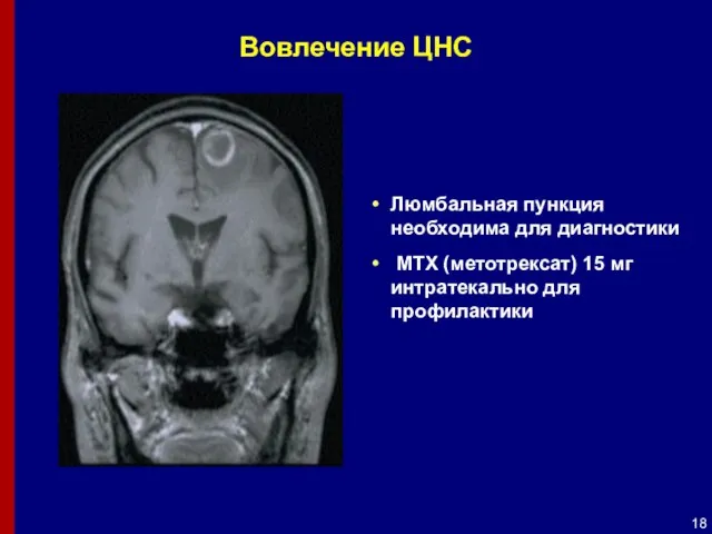 Вовлечение ЦНС Люмбальная пункция необходима для диагностики MTX (метотрексат) 15 мг интратекально для профилактики