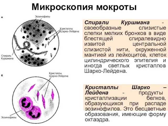 Микроскопия мокроты Спирали Куршмана - своеобразные слизистые слепки мелких бронхов в виде