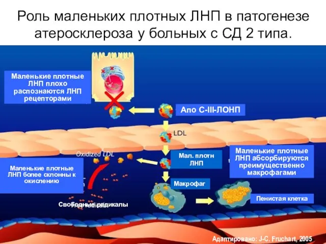 Роль маленьких плотных ЛНП в патогенезе атеросклероза у больных с СД 2