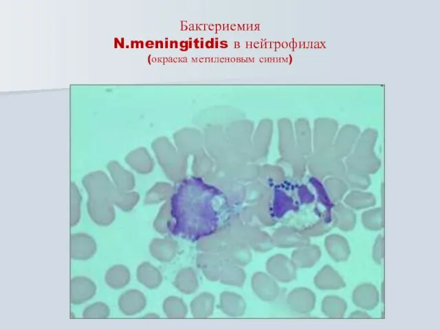 Бактериемия N.meningitidis в нейтрофилах (окраска метиленовым синим)
