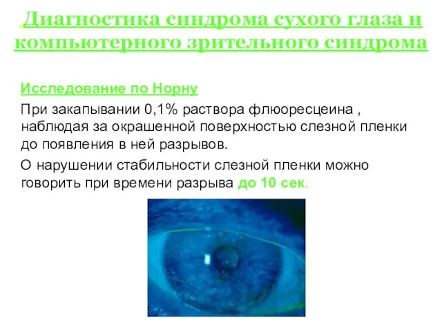 Диагностика синдрома сухого глаза и компьютерного зрительного синдрома Исследование по Норну При