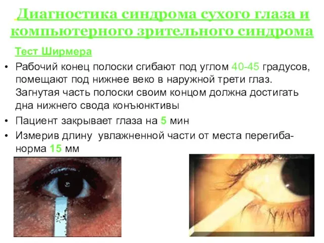 Диагностика синдрома сухого глаза и компьютерного зрительного синдрома Тест Ширмера Рабочий конец