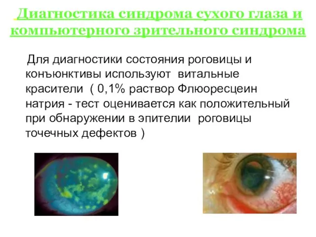 Диагностика синдрома сухого глаза и компьютерного зрительного синдрома Для диагностики состояния роговицы
