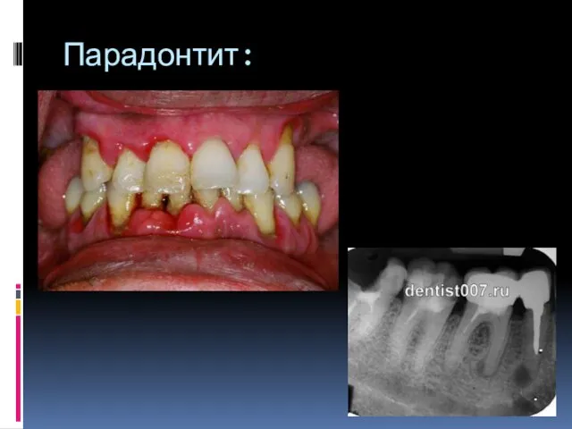 Парадонтит: