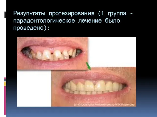 Результаты протезирования (1 группа - парадонтологическое лечение было проведено):