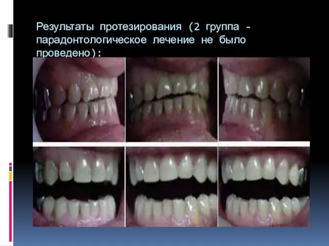 Результаты протезирования (2 группа - парадонтологическое лечение не было проведено):