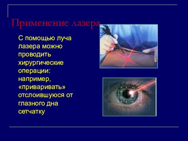 Применение лазера С помощью луча лазера можно проводить хирургические операции: например, «приваривать»