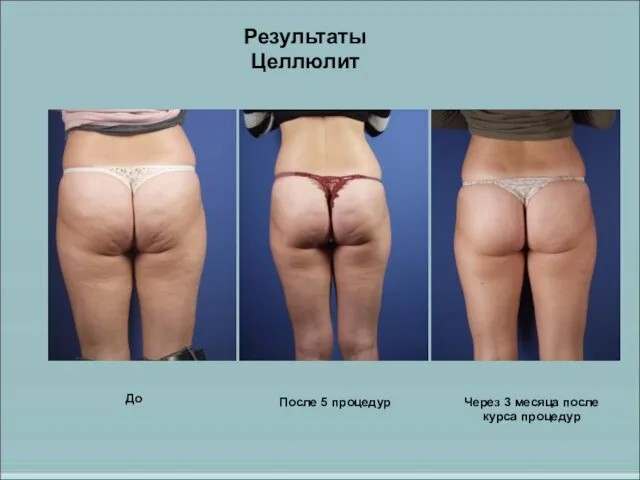 До После 5 процедур Через 3 месяца после курса процедур Результаты Целлюлит