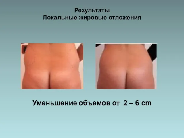 Результаты Локальные жировые отложения Уменьшение объемов от 2 – 6 cm