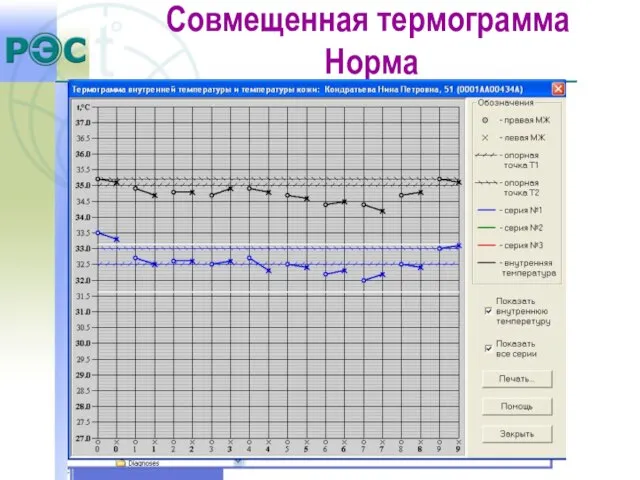 Совмещенная термограмма Норма