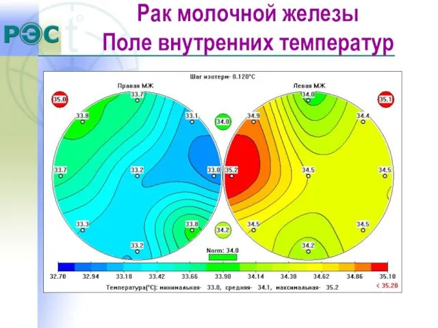 Рак молочной железы Поле внутренних температур