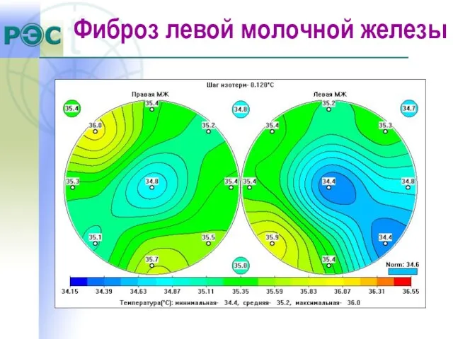 Фиброз левой молочной железы