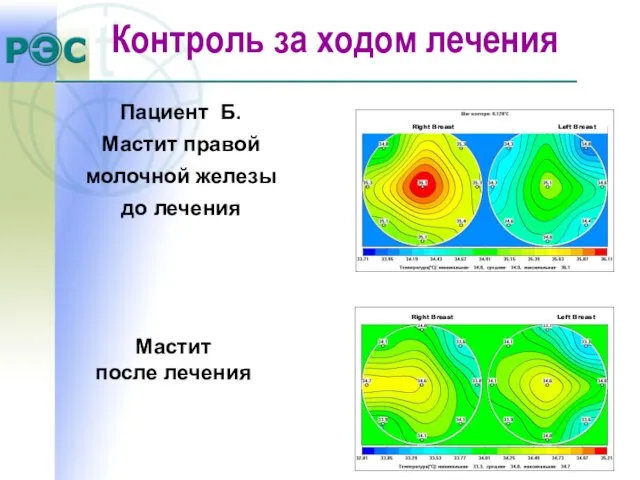 Пациент Б. Мастит правой молочной железы до лечения Мастит после лечения Контроль за ходом лечения