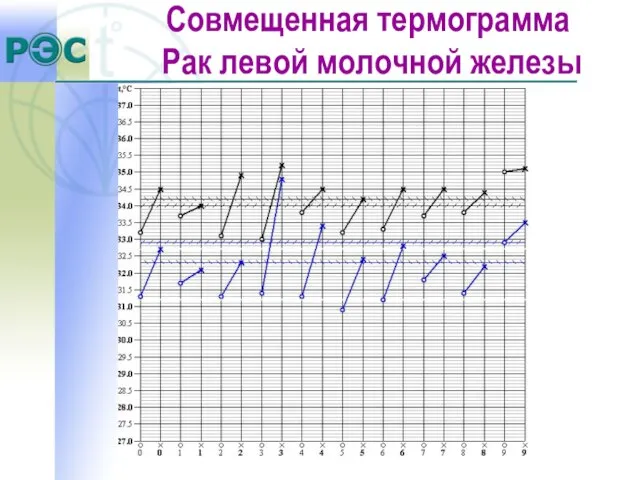 Совмещенная термограмма Рак левой молочной железы