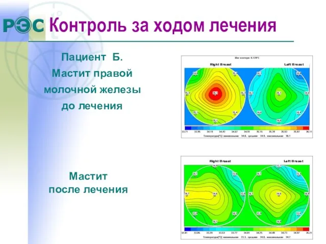 Пациент Б. Мастит правой молочной железы до лечения Мастит после лечения Контроль за ходом лечения