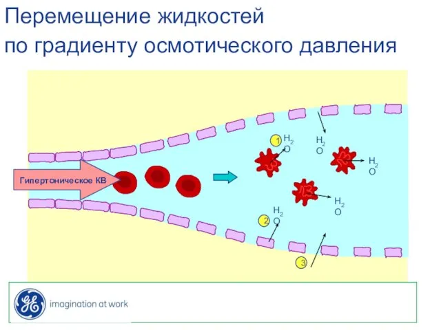 Гипертоническое КВ Перемещение жидкостей по градиенту осмотического давления