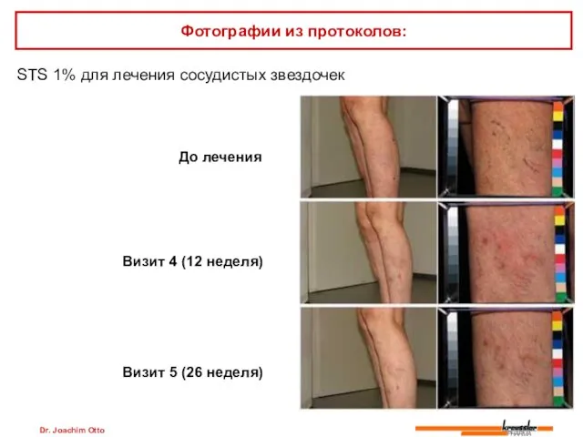 Dr. Joachim Otto STS 1% для лечения сосудистых звездочек Фотографии из протоколов: