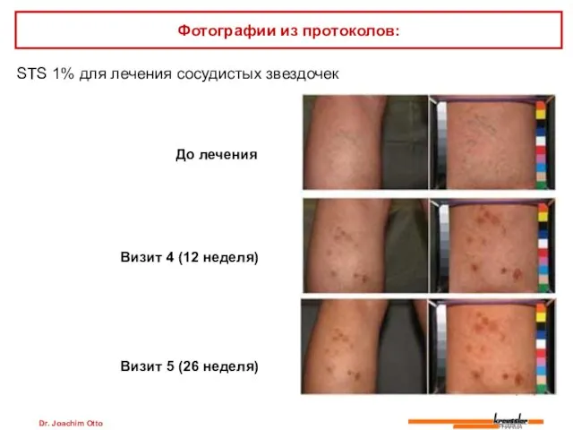 Dr. Joachim Otto STS 1% для лечения сосудистых звездочек Фотографии из протоколов: