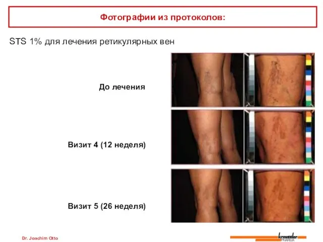 Dr. Joachim Otto STS 1% для лечения ретикулярных вен Фотографии из протоколов: