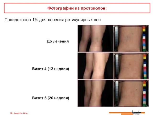 Dr. Joachim Otto Полидоканол 1% для лечения ретикулярных вен Фотографии из протоколов: