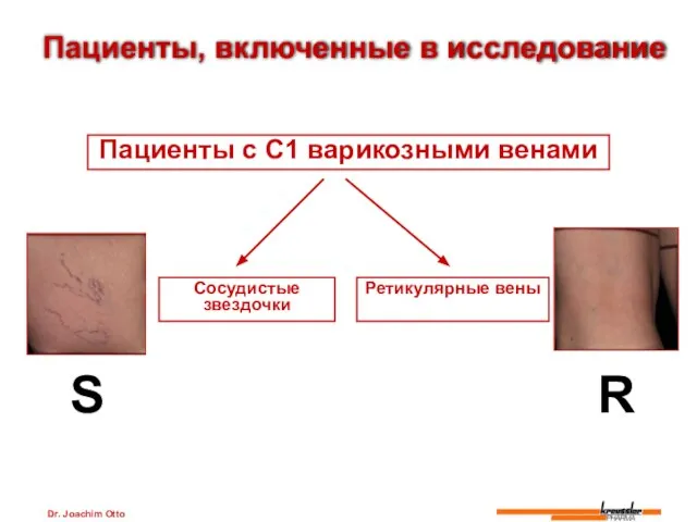 Dr. Joachim Otto Сосудистые звездочки Ретикулярные вены Пациенты с C1 варикозными венами