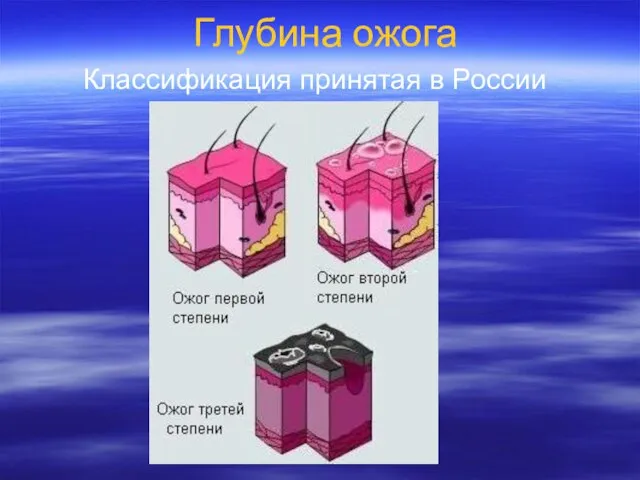 Глубина ожога Классификация принятая в России