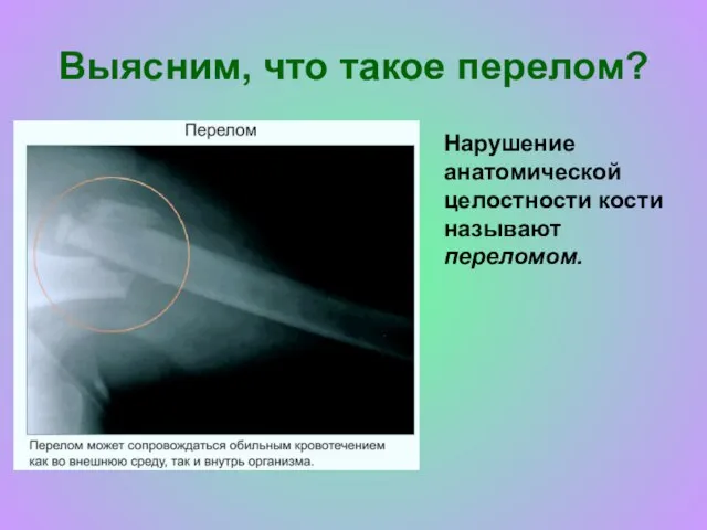 Выясним, что такое перелом? Нарушение анатомической целостности кости называют переломом.