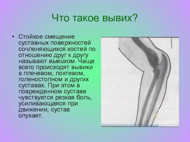 Что такое вывих? Стойкое смещение суставных поверхностей сочленяющихся костей по отношению друг