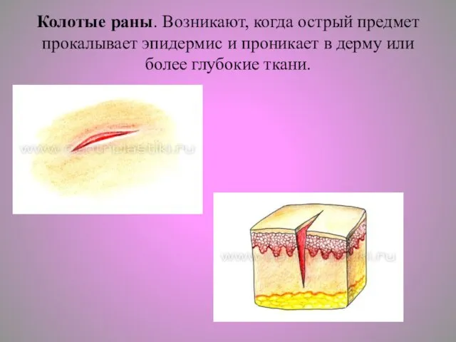 Колотые раны. Возникают, когда острый предмет прокалывает эпидермис и проникает в дерму или более глубокие ткани.