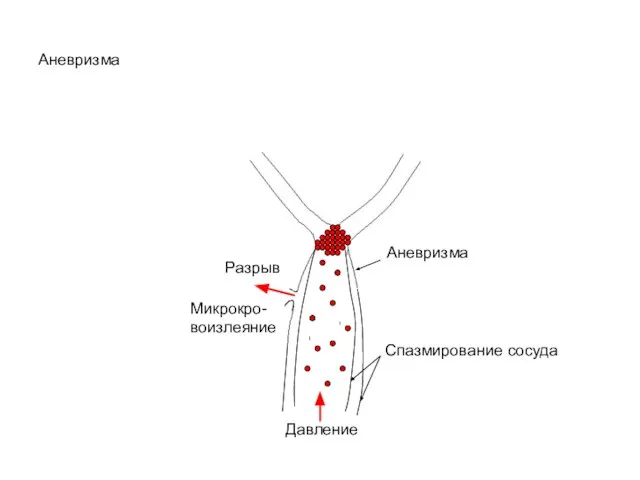 Аневризма Аневризма Спазмирование сосуда Давление Разрыв Микрокро-воизлеяние