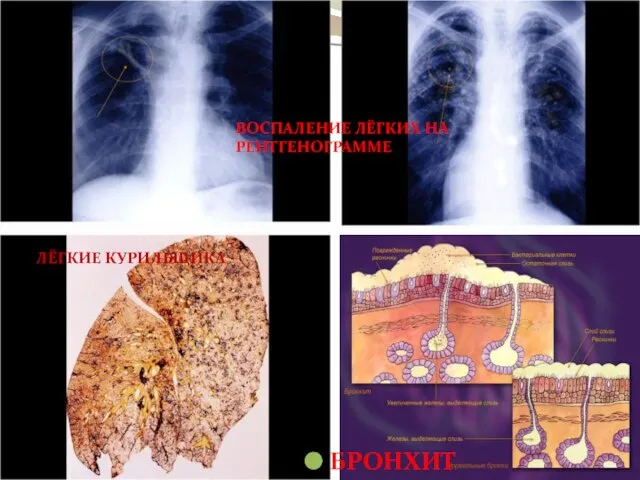 ВОСПАЛЕНИЕ ЛЁГКИХ НА РЕНТГЕНОГРАММЕ БРОНХИТ ЛЁГКИЕ КУРИЛЬЩИКА