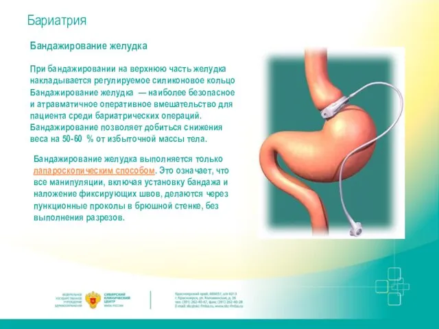 Бариатрия Бандажирование желудка При бандажировании на верхнюю часть желудка накладывается регулируемое силиконовое